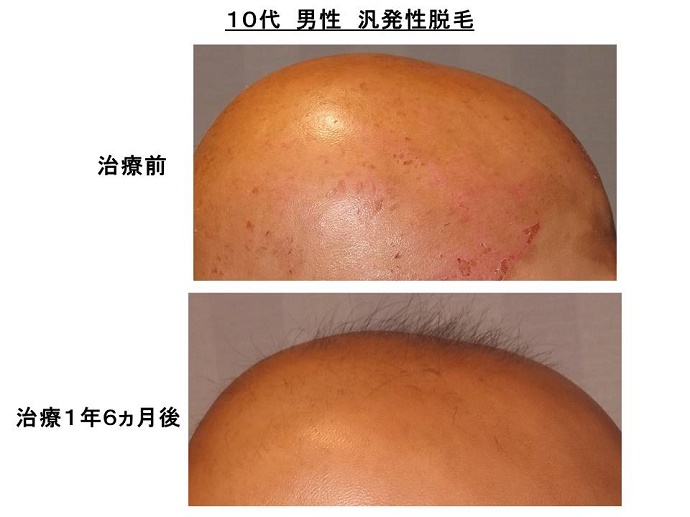 汎発性脱毛　病院""